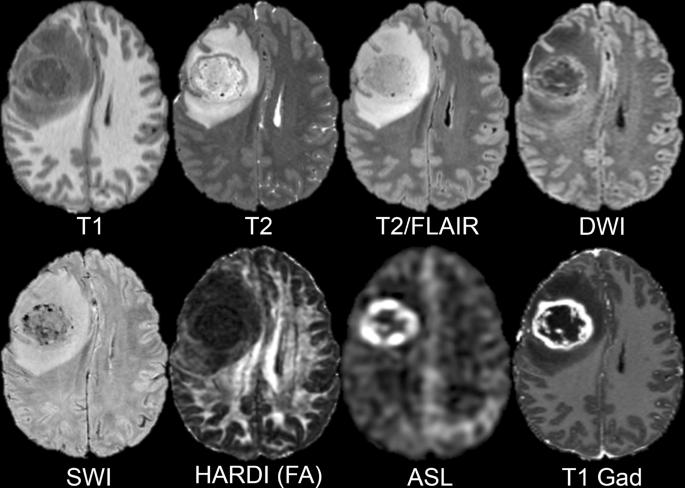 不同 MRI 序列的影像示意，非本项目患者数据